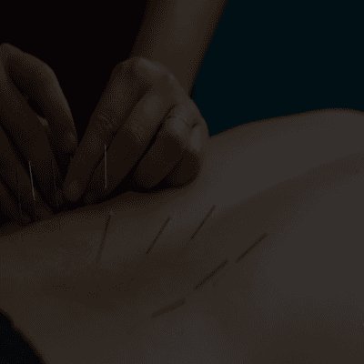 Dry Needling and Acupuncture at Amazing Physiotherapy