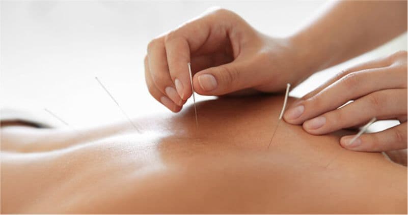 Acupuncture at Amazing Physiotherapy